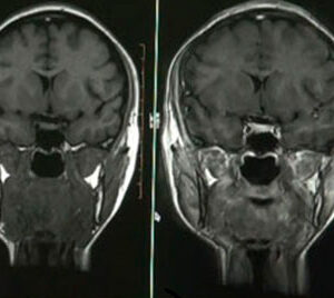 Curso de protocolos avanzados de neuro-resonancia magnética