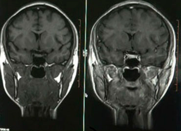 Curso de protocolos avanzados de neuro-resonancia magnética