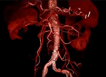 Curso de últimos avances en protocolos y principios de la angiotomografía torácica y abdominal